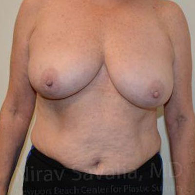 Case--1655496 | Before Breast Reduction