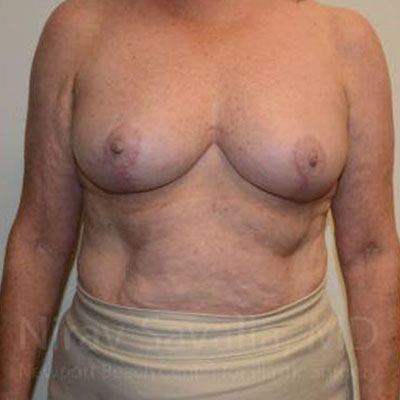 Case--1655496 | After Breast Reduction