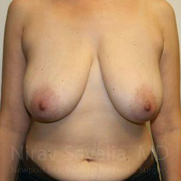 Case--1655527 | Before Breast Reduction