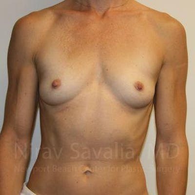 Case--1655561 | Before Breast Augmentation