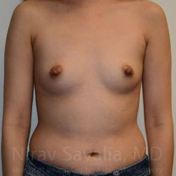 Case--1655566 | Before Breast Augmentation