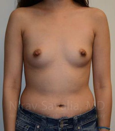 Case--1655566 | Before Breast Augmentation