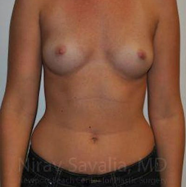 Case--1655574 | Before Breast Augmentation