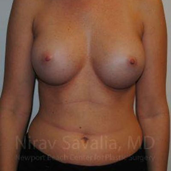 Case--1655574 | After Breast Augmentation