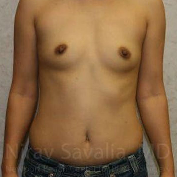Case--1655576 | Before Breast Augmentation