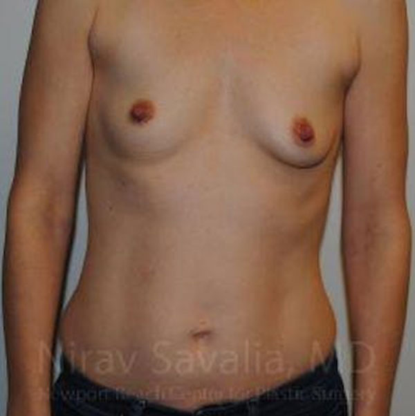 Case--1655580 | Before Breast Augmentation