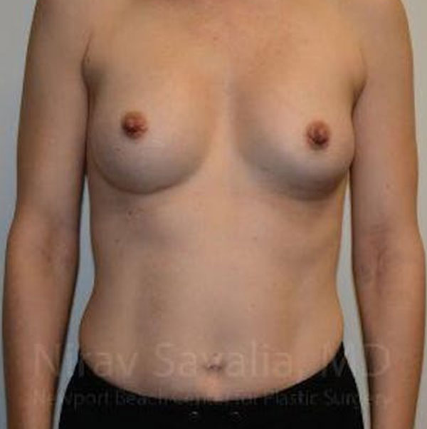Case--1655580 | After Breast Augmentation