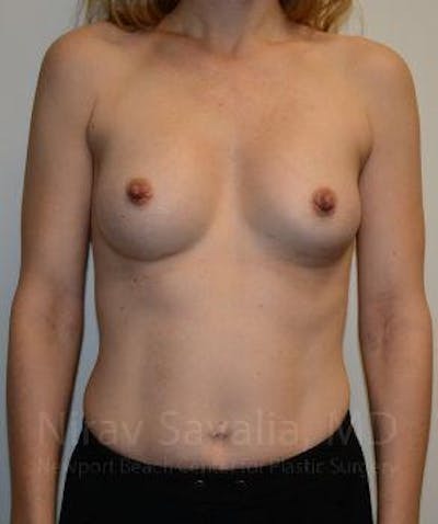 Case--1655580 | After Breast Augmentation