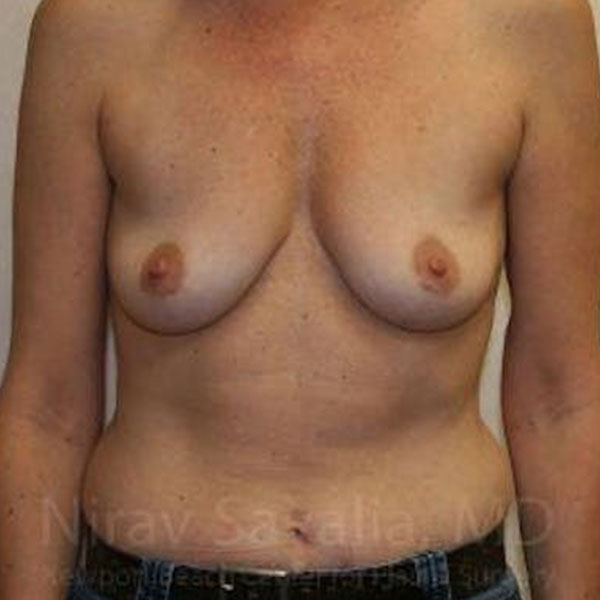 Case--1655587 | Before Breast Augmentation