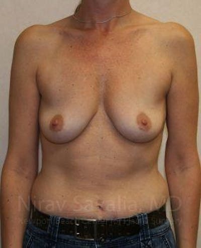 Case--1655587 | Before Breast Augmentation