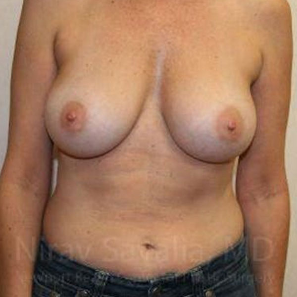 Case--1655587 | After Breast Augmentation