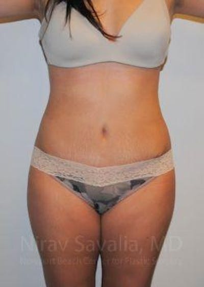 Case--1655598 | After Abdominoplasty Tummy Tuck