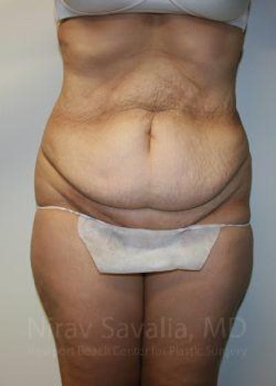 Case--1655601 | Before Abdominoplasty Tummy Tuck