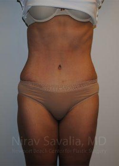 Case--1655601 | After Abdominoplasty Tummy Tuck