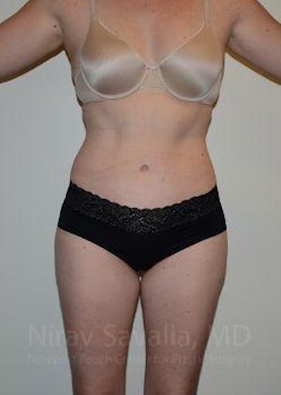 Case--1655605 | After Abdominoplasty Tummy Tuck