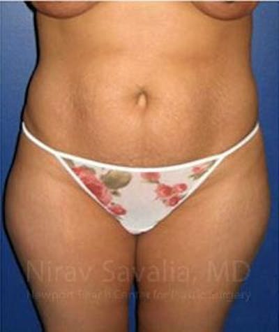 Case--1655614 | Before Abdominoplasty Tummy Tuck