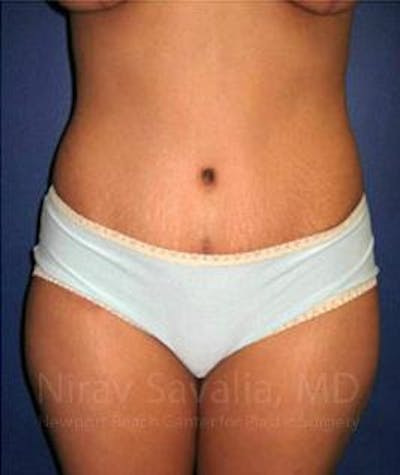 Case--1655614 | After Abdominoplasty Tummy Tuck