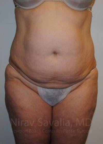 Case--1655617 | Before Abdominoplasty Tummy Tuck