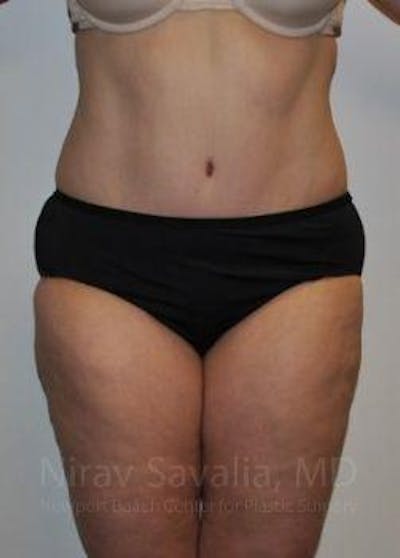 Case--1655617 | After Abdominoplasty Tummy Tuck