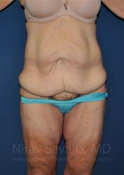 Case--1655638 | Before Abdominoplasty Tummy Tuck