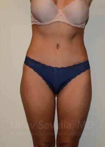 Case--1655645 | After Abdominoplasty Tummy Tuck
