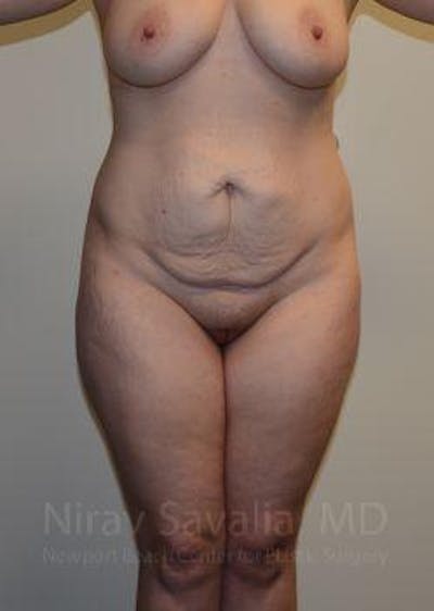 Case--1655670 | Before Abdominoplasty Tummy Tuck