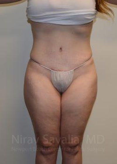 Case--1655670 | After Abdominoplasty Tummy Tuck