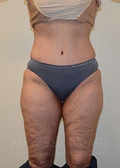 Case--1655672 | After Abdominoplasty Tummy Tuck