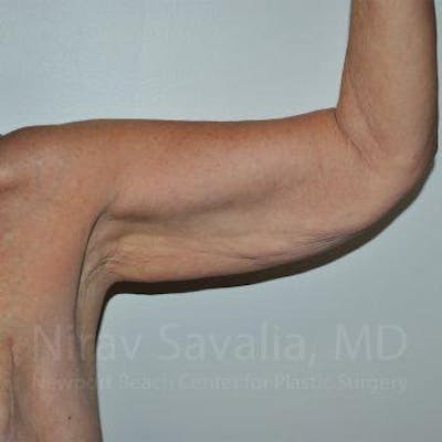Case--1655610 | Before Arm Lift