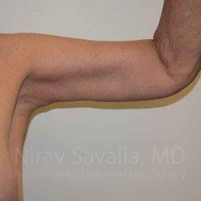 Case--1655610 | After Arm Lift