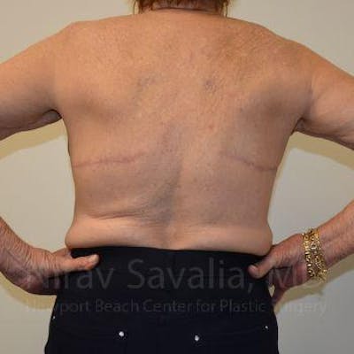Case--1655616 | After Body Contouring After Weight Loss