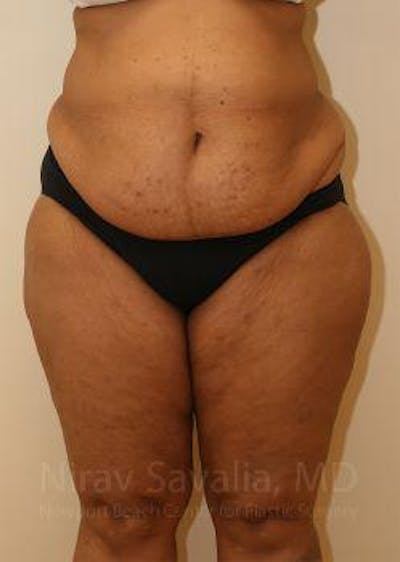 Case--1655636 | Before Body Contouring After Weight Loss