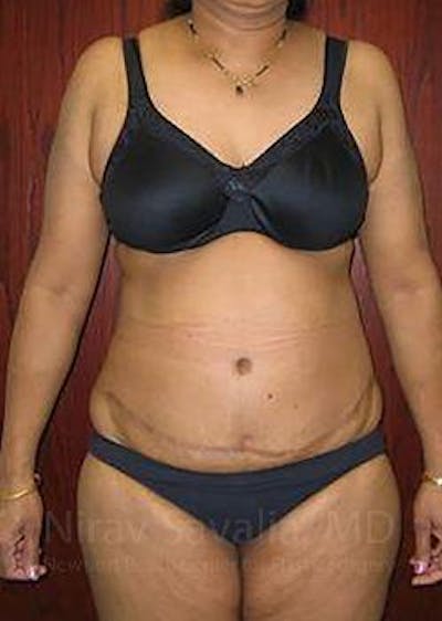 Case--1655636 | After Body Contouring After Weight Loss