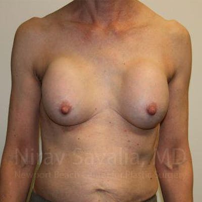 Case--1655447 | Before Breast Implant Revision