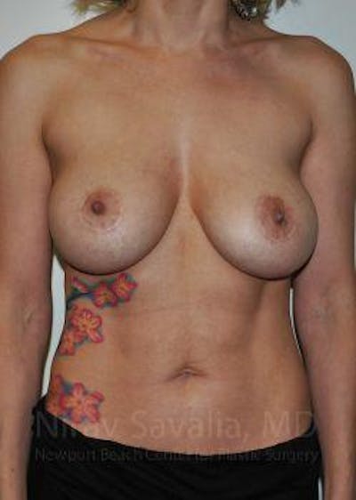 Case--1655455 | Before Breast Lift With Implants