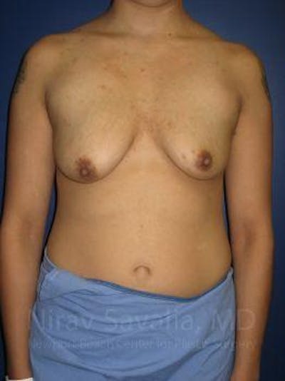 Case--1655508 | Before Breast Lift With Implants