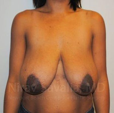 Case--1655451 | Before Breast Reduction