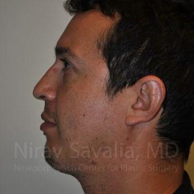 Case--1655678 | After Chin Implants