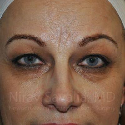 Case--1655701 | Before Eyelid Surgery