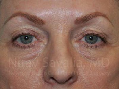 Case--1655707 | Before Eyelid Surgery