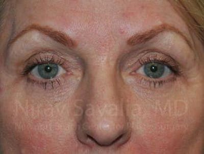 Case--1655707 | After Eyelid Surgery