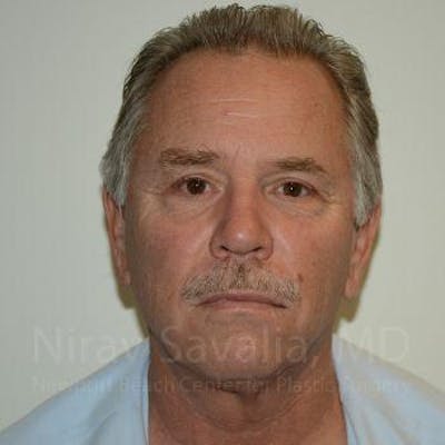 Case--1655711 | After Eyelid Surgery