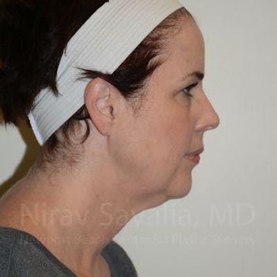 Case--1655689 | Before Facelift