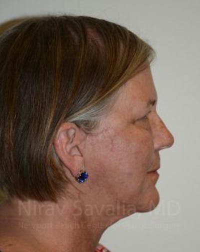 Case--1655699 | After Facelift