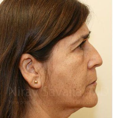 Case--1655721 | Before Facelift