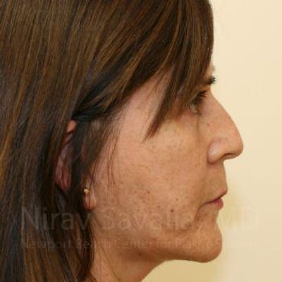 Case--1655721 | After Facelift