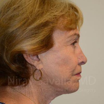 Case--1655786 | After Facelift