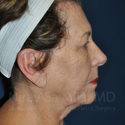 Case--1655791 | Before Facelift