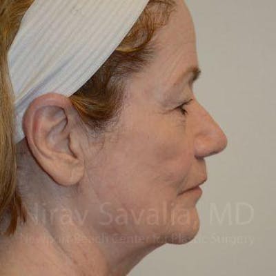Case--1655795 | Before Facelift