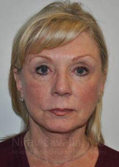 Case--1655681 | After Fat Grafting To Face